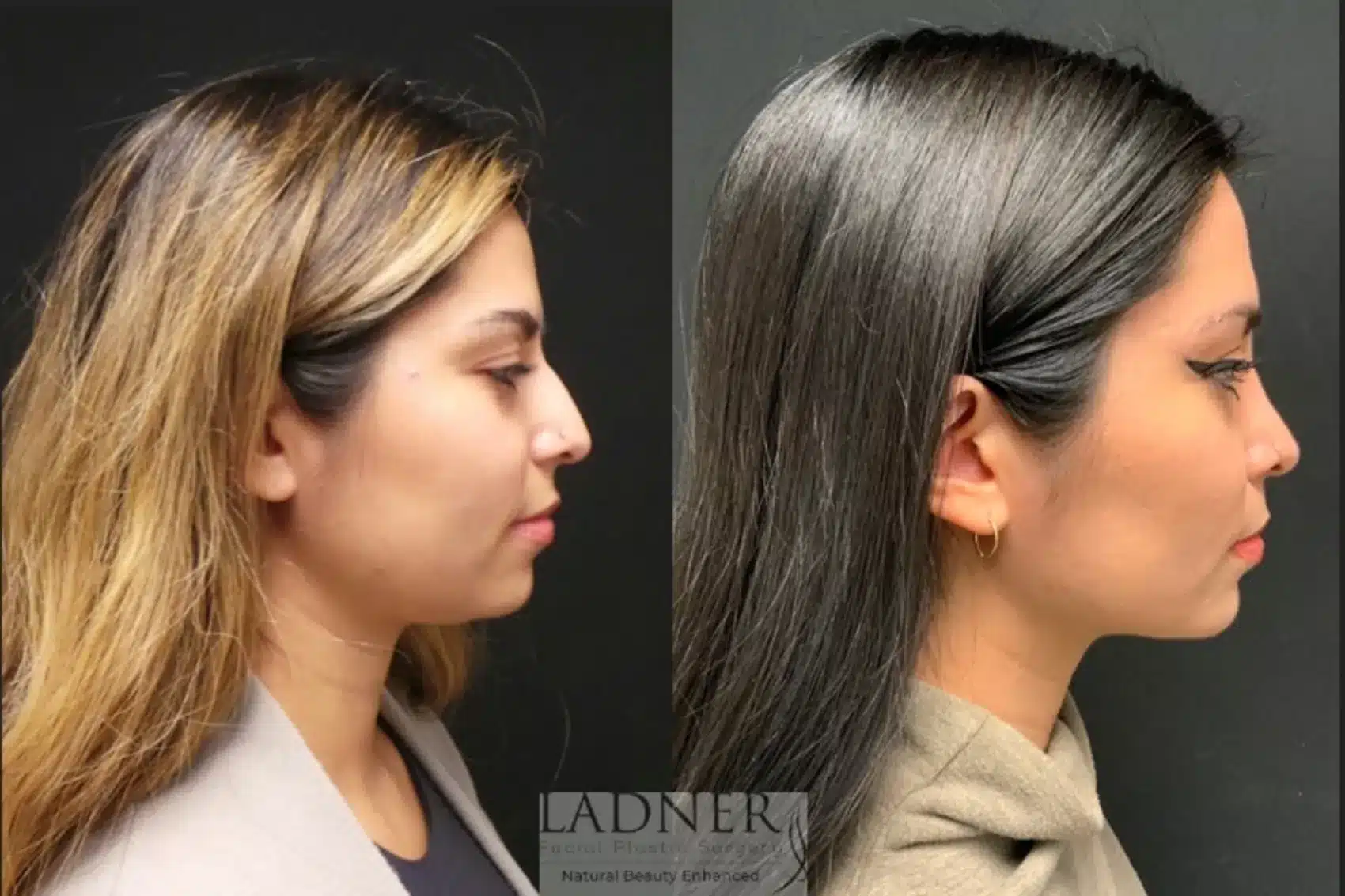 Before and After Image: Rhinoplasty - right-side
