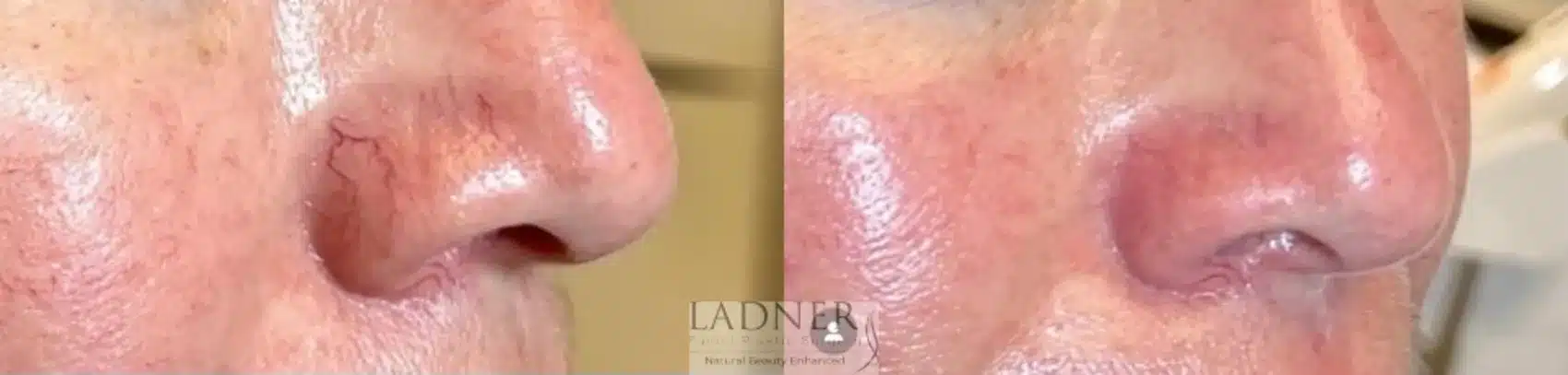 Before and After Image: Skin Treatments - right-front-oblique