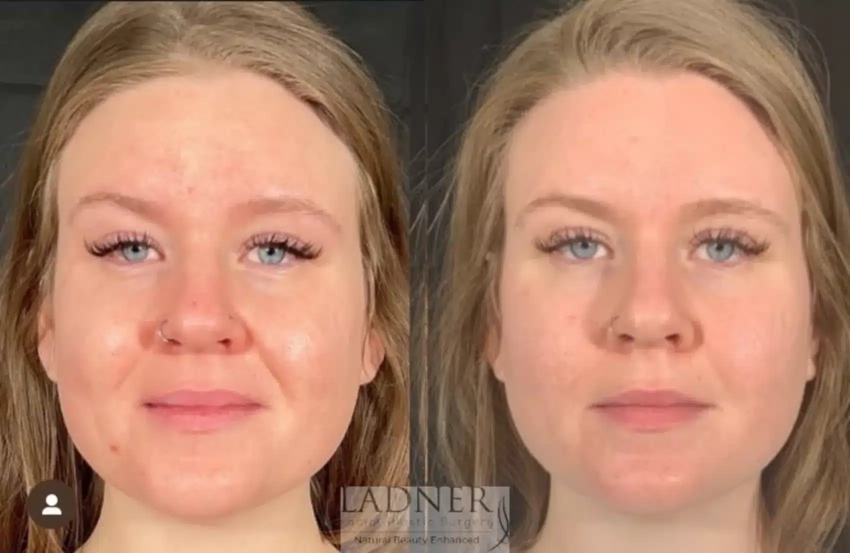 Before and After Image: Skin Treatments - front