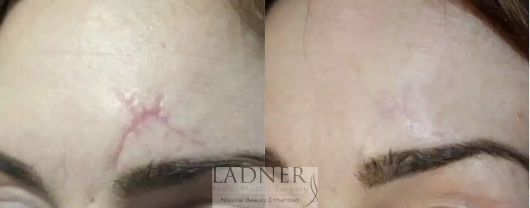 Before and After Image: Skin Treatments - left-front-oblique