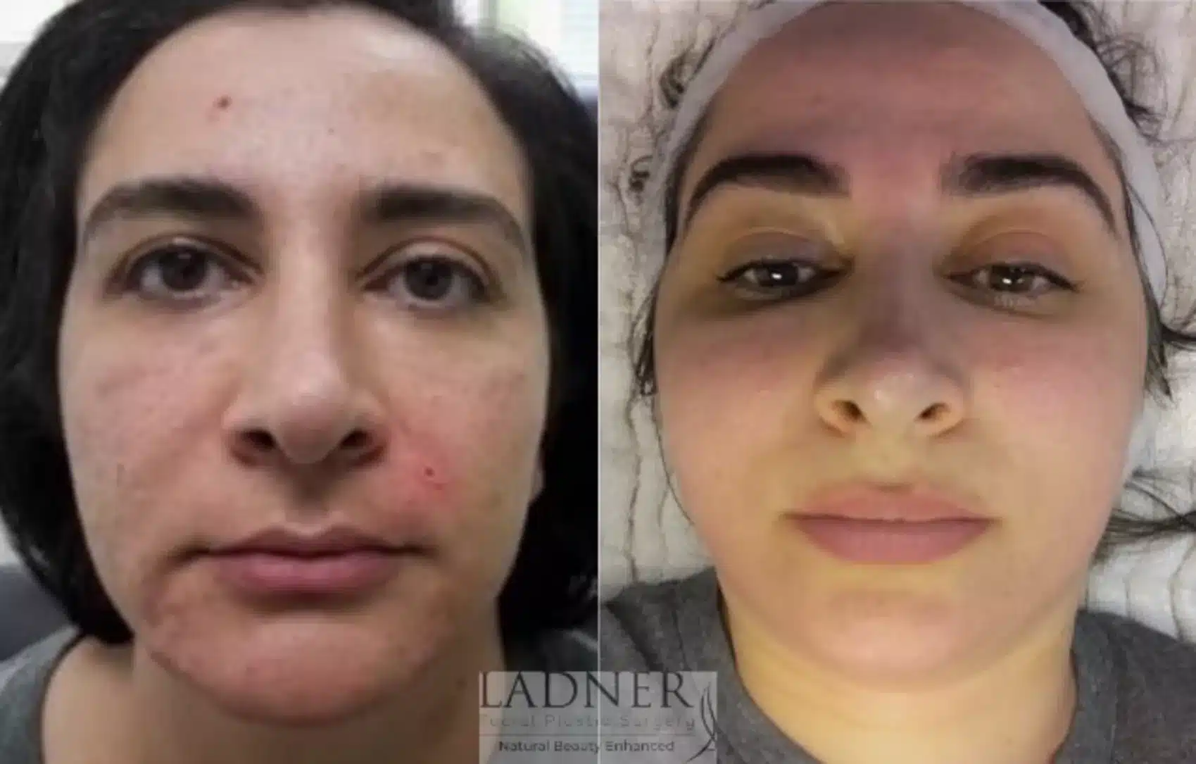 Before and After Image: Skin Treatments - front