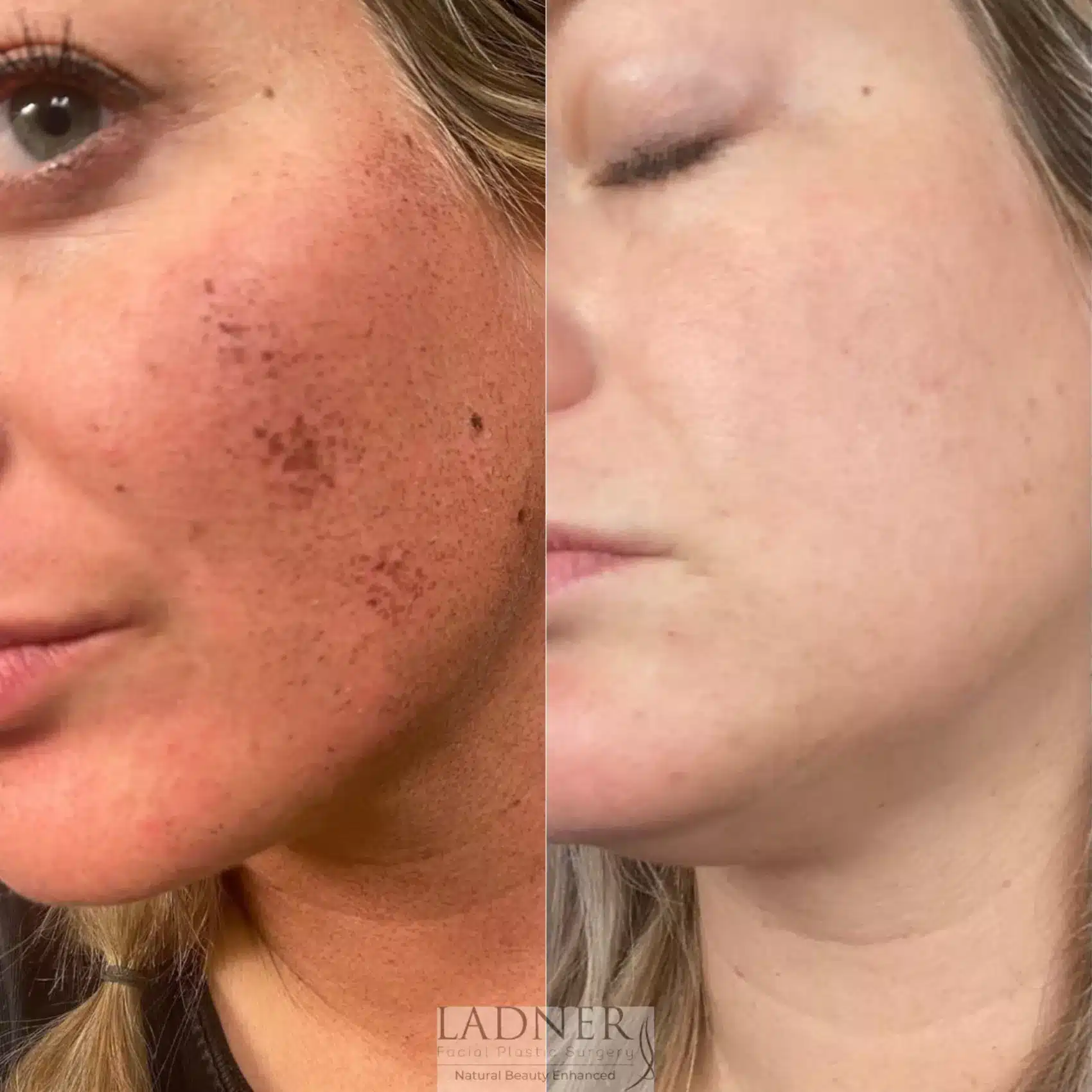 Before and After Image: Skin Treatments - left-front-oblique