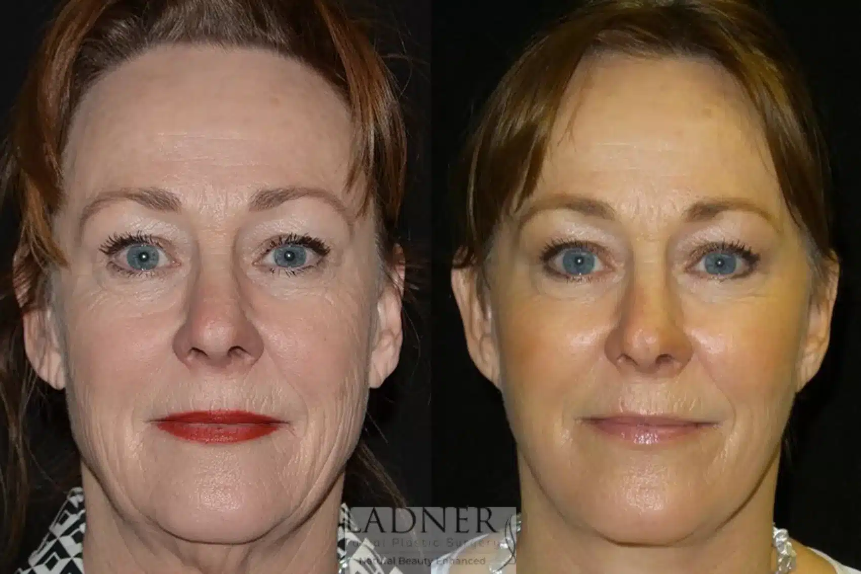 Before and After Image: Deep Plane Facelift/Neck Lift - front