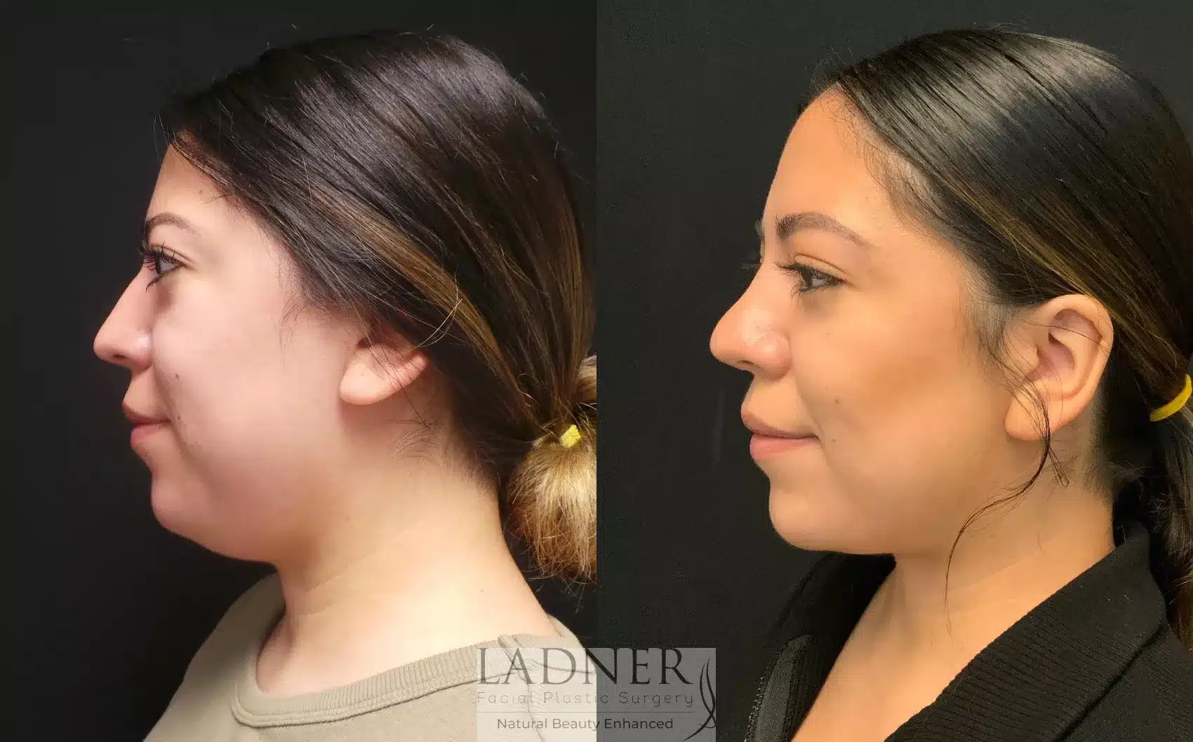 Before and After Image: Submental Liposuction - left-side