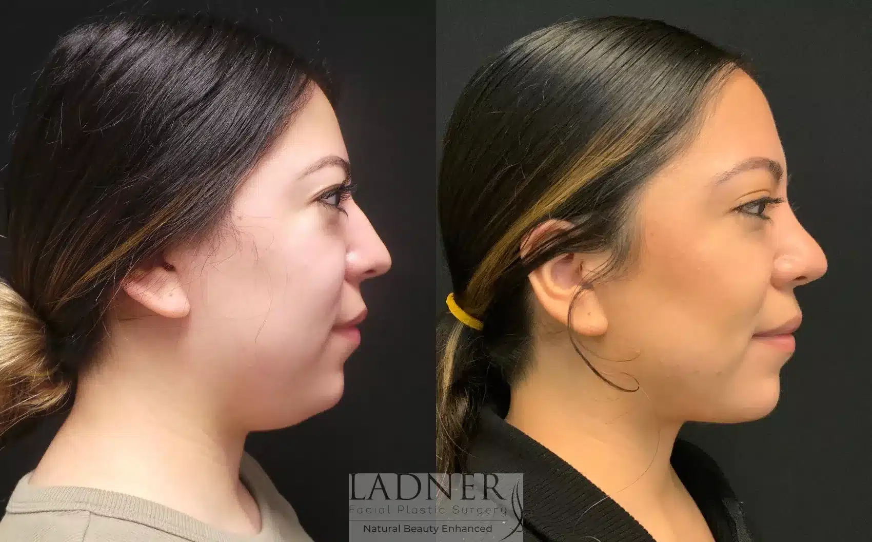 Before and After Image: Submental Liposuction - right-side