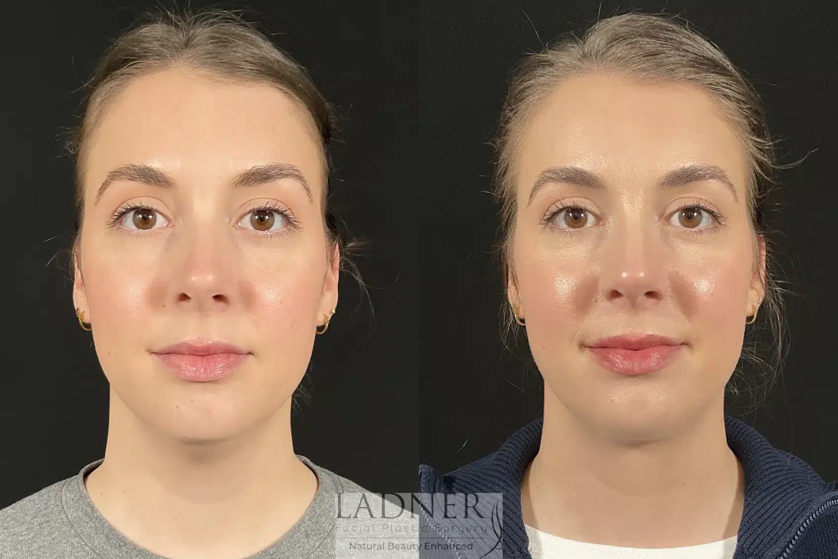 Before and After Image: Submental Liposuction - front