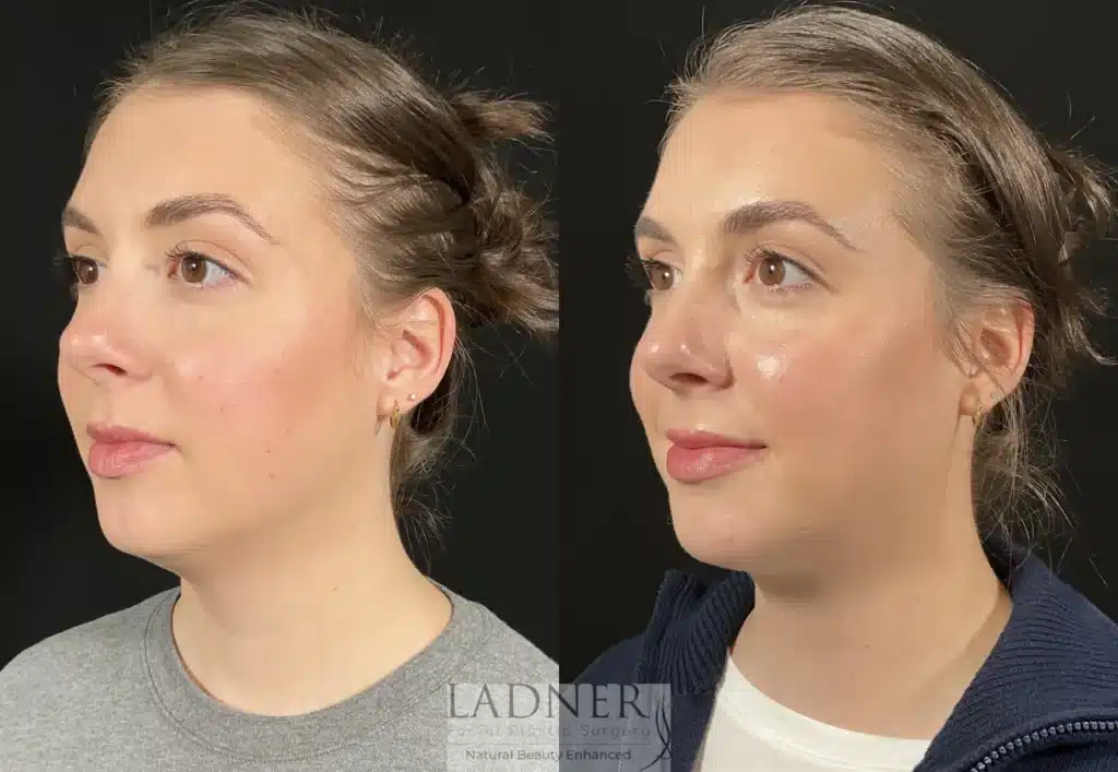 Before and After Image: Submental Liposuction - left-front-oblique