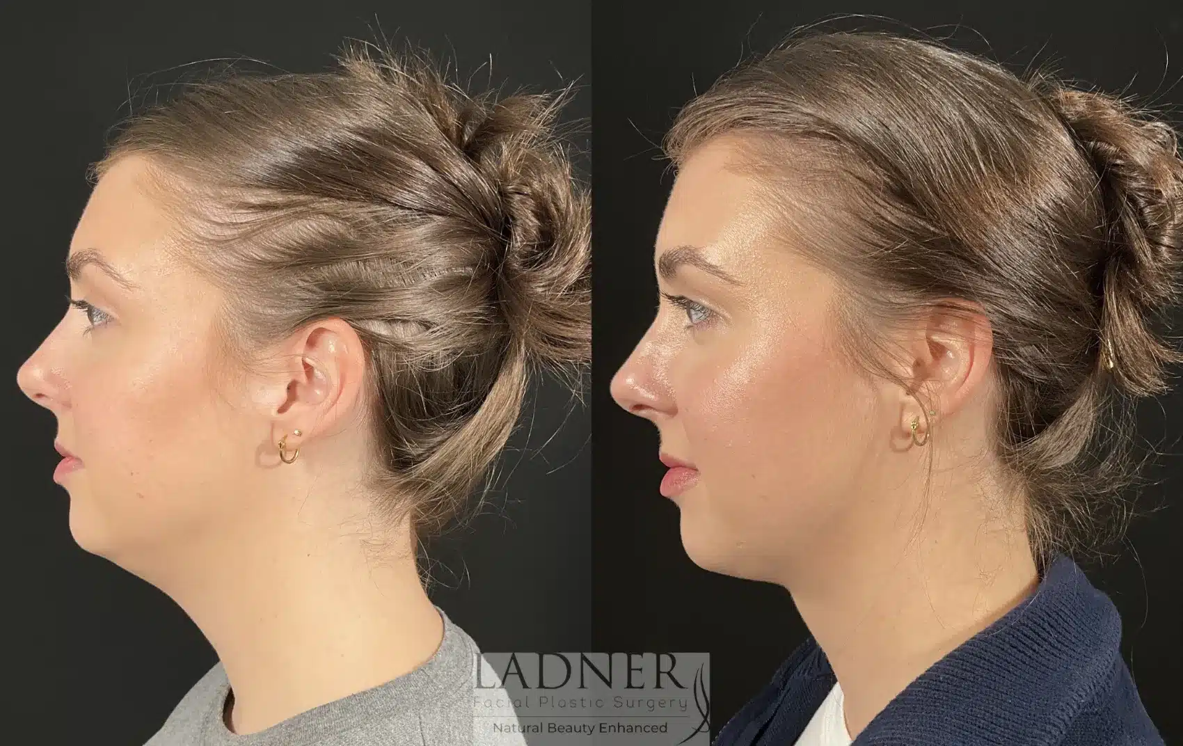 Before and After Image: Submental Liposuction - left-side