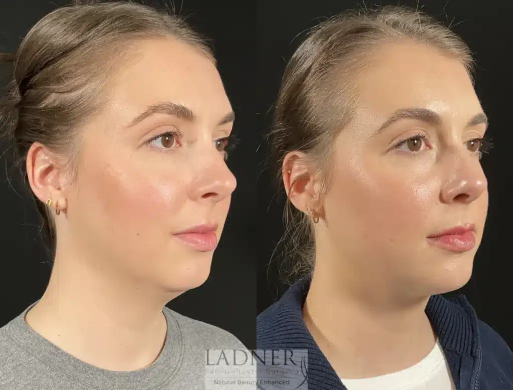 Before and After Image: Submental Liposuction - right-front-oblique