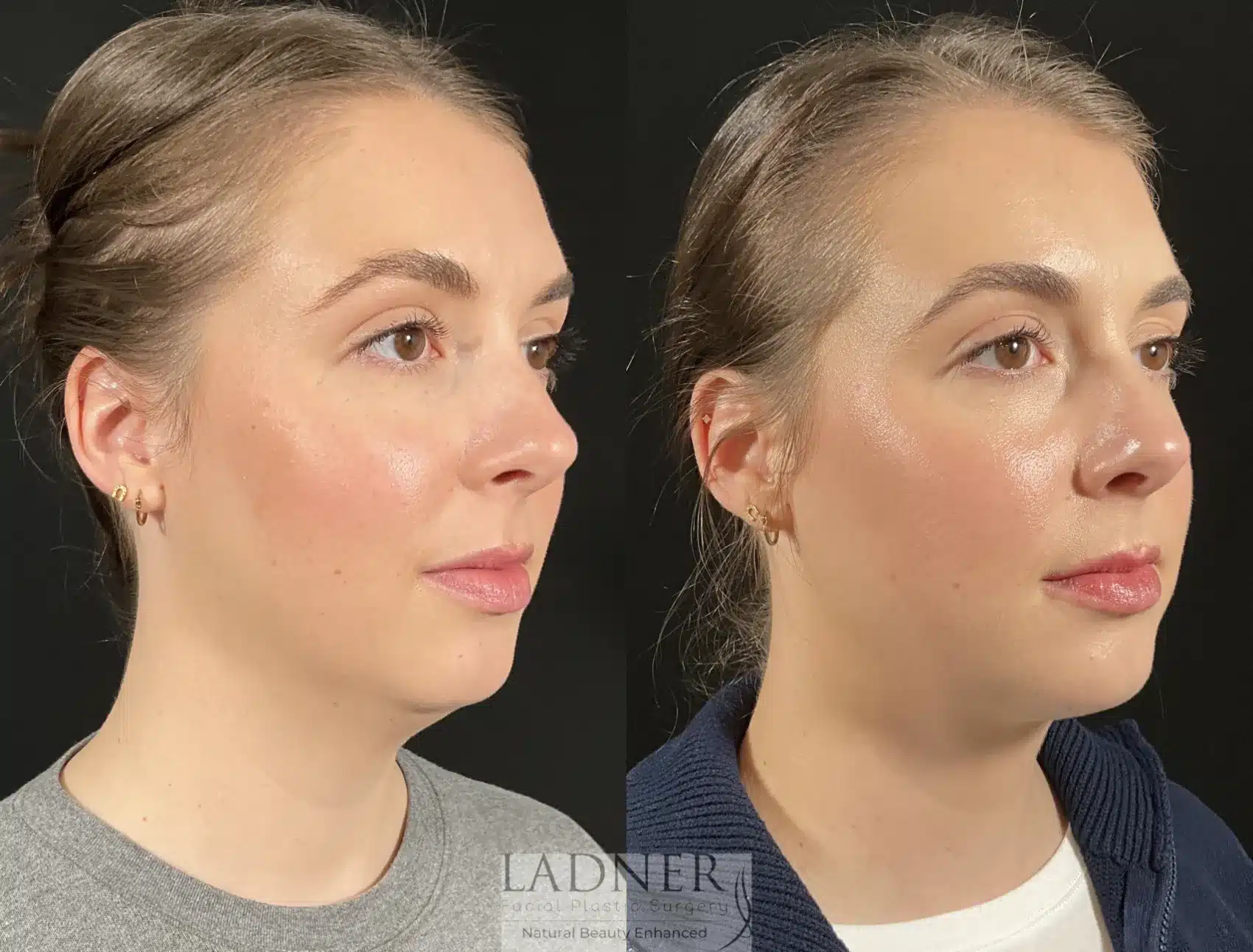 Before and After Image: Submental Liposuction - right-front-oblique