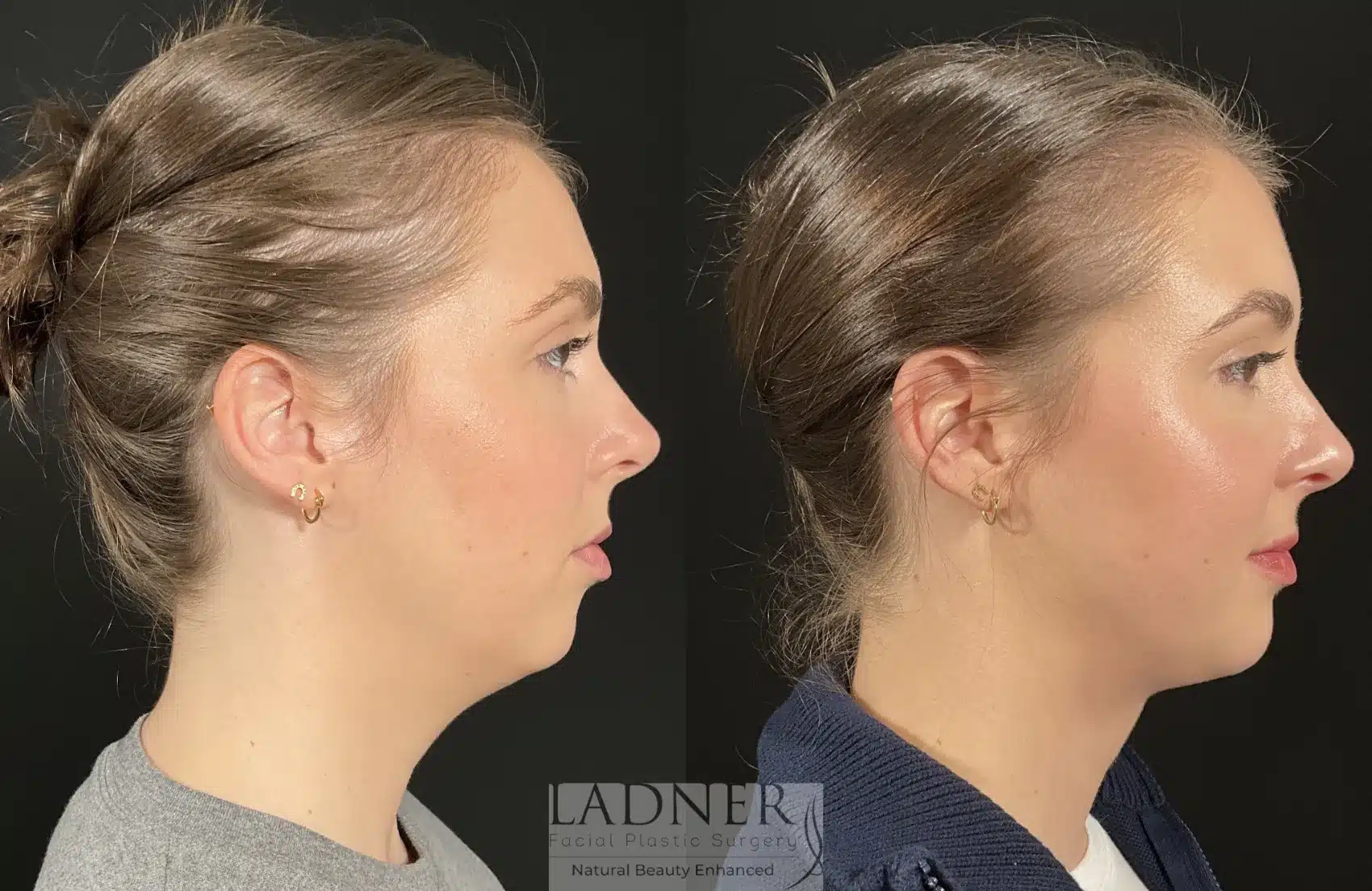 Before and After Image: Submental Liposuction - right-side