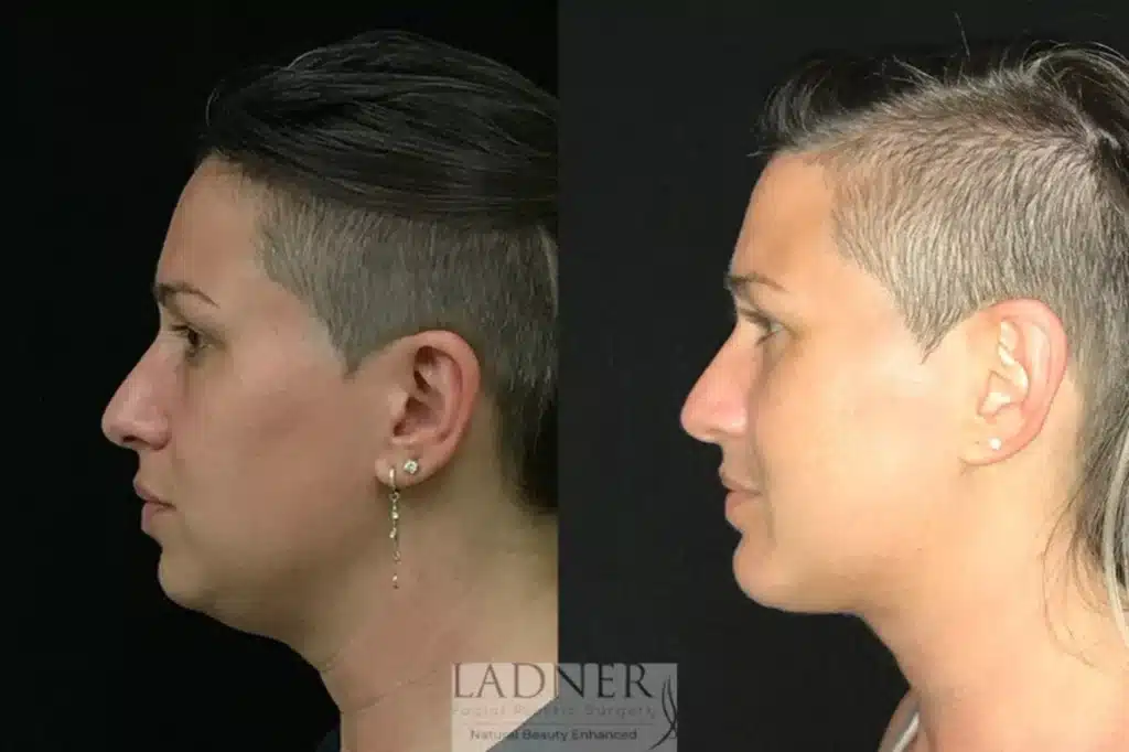 Before and After Image: Submental Liposuction - left-side