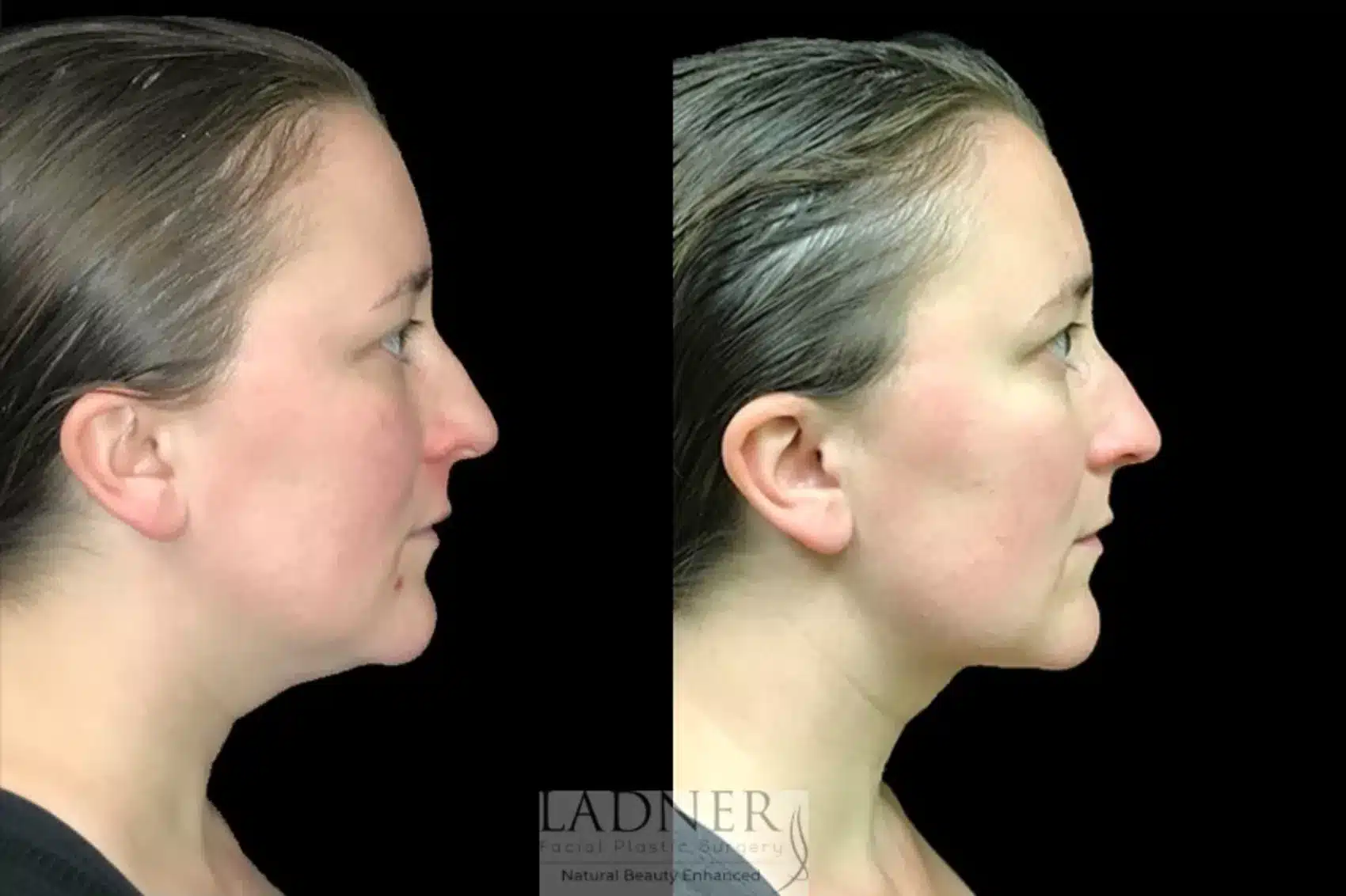 Before and After Image: Submental Liposuction - right-side