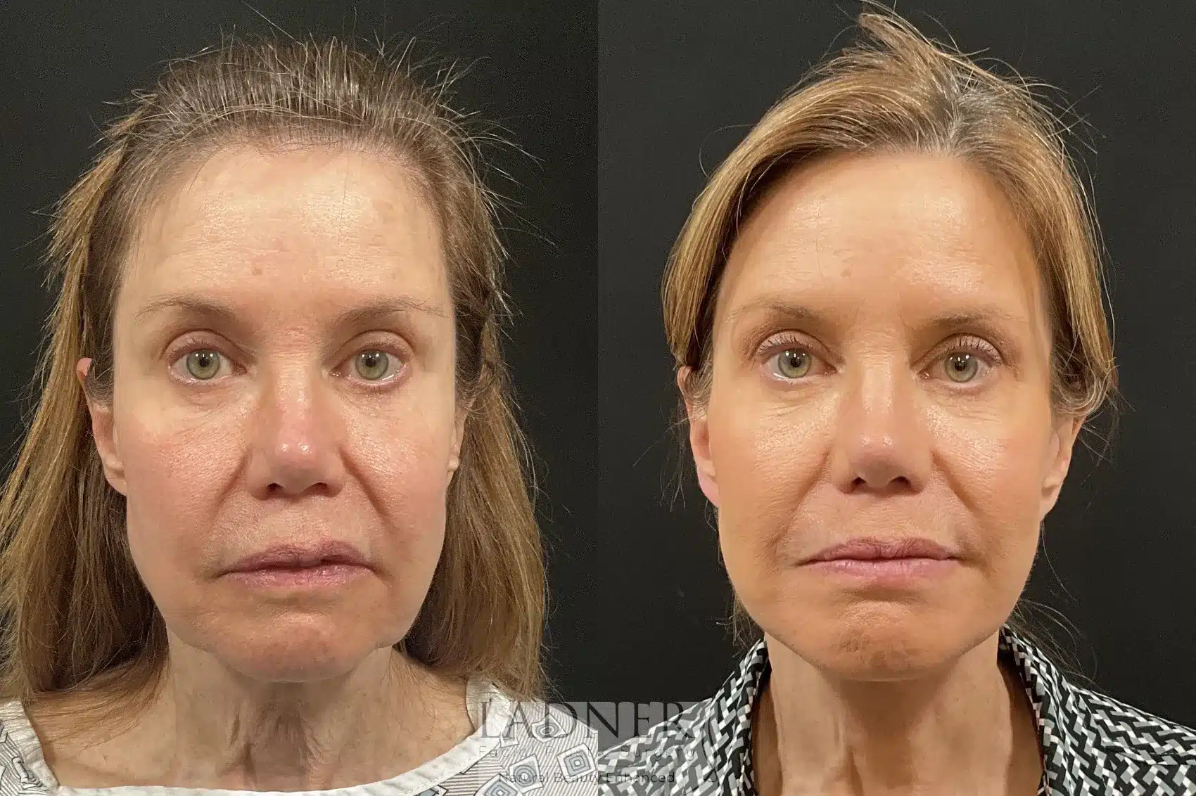 Before and After Image: Deep Plane Facelift / Neck Lift - front