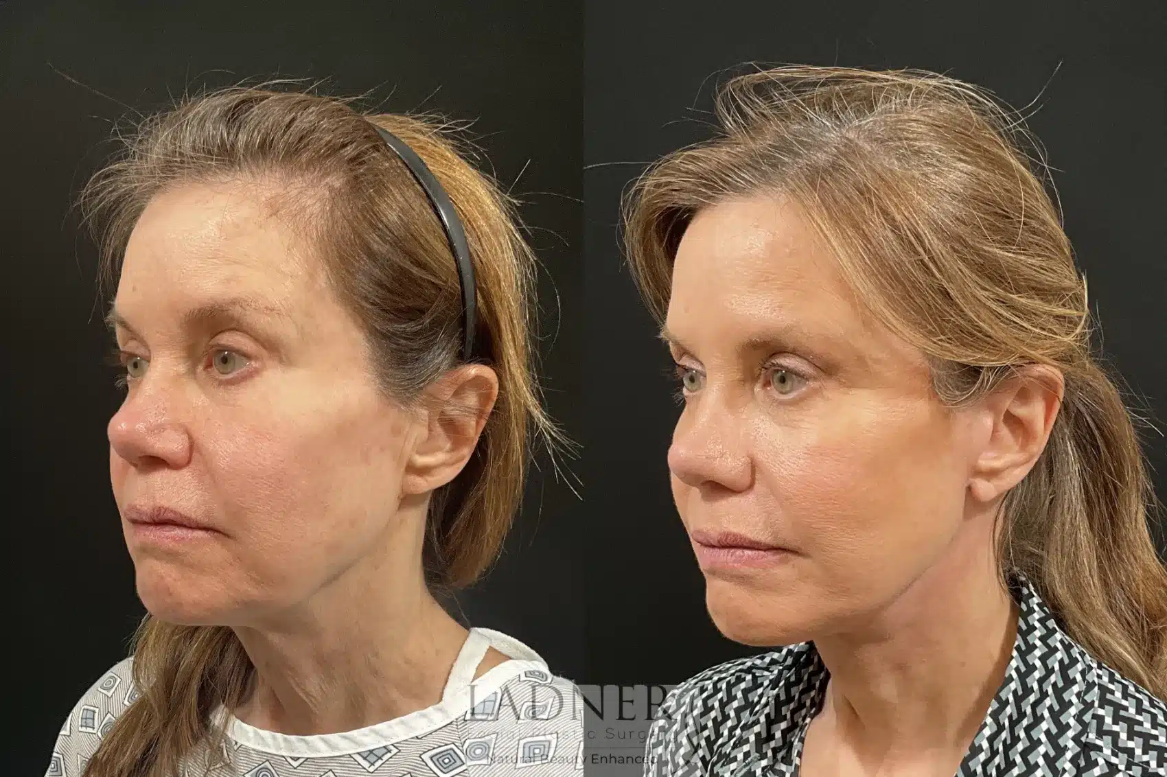 Before and After Image: Deep Plane Facelift / Neck Lift - left-front-oblique