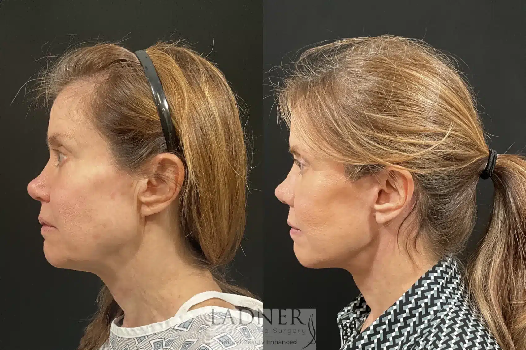 Before and After Image: Deep Plane Facelift / Neck Lift - left-side