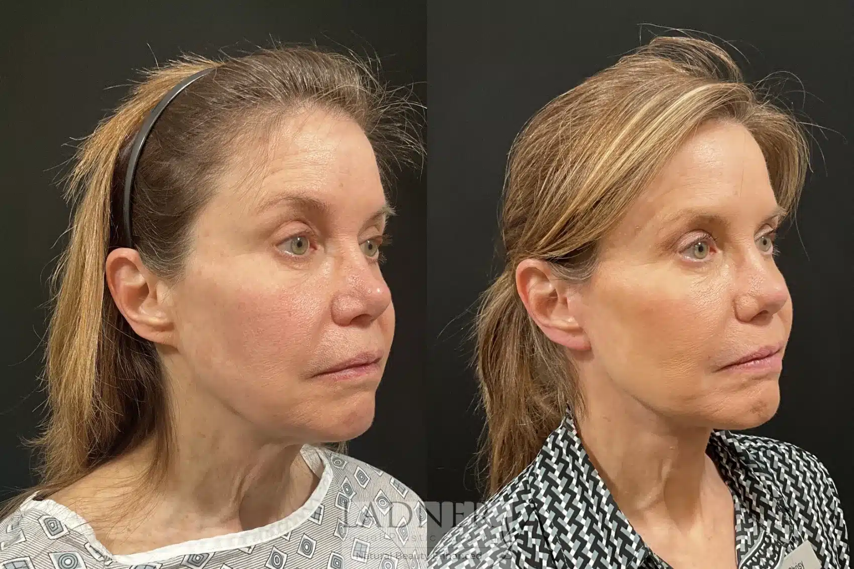 Before and After Image: Deep Plane Facelift / Neck Lift - right-front-oblique