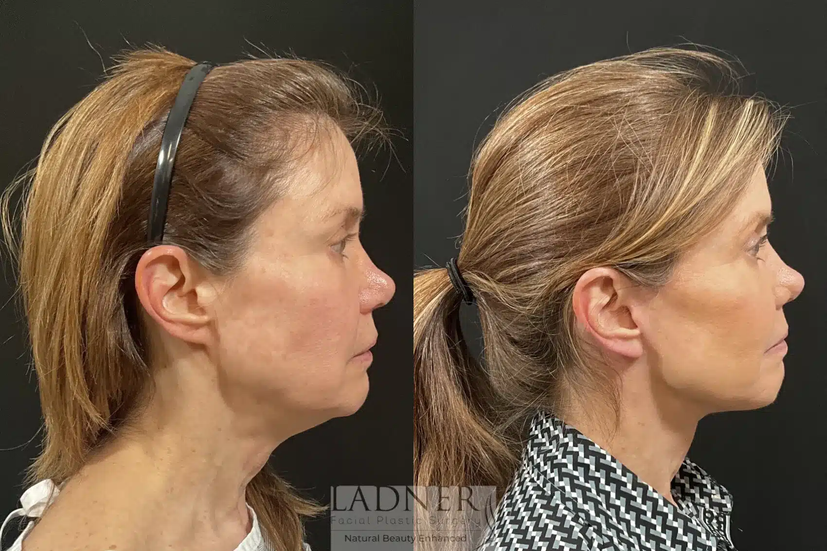 Before and After Image: Deep Plane Facelift / Neck Lift - right-side