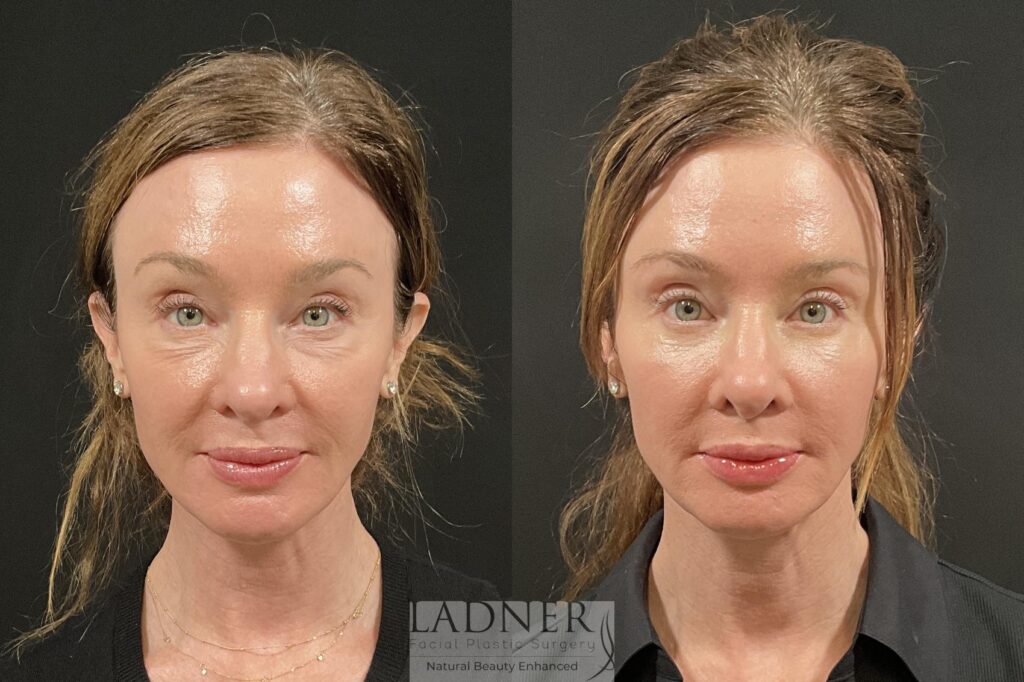 Before and After Image: Lower Blepharoplasty & Facial Fat Transfer - front