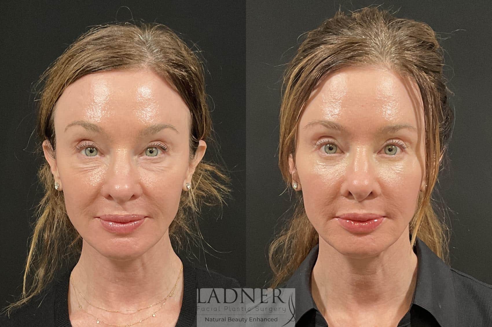 Before and After Image: Eyelid Surgery (Blepharoplasty) - front