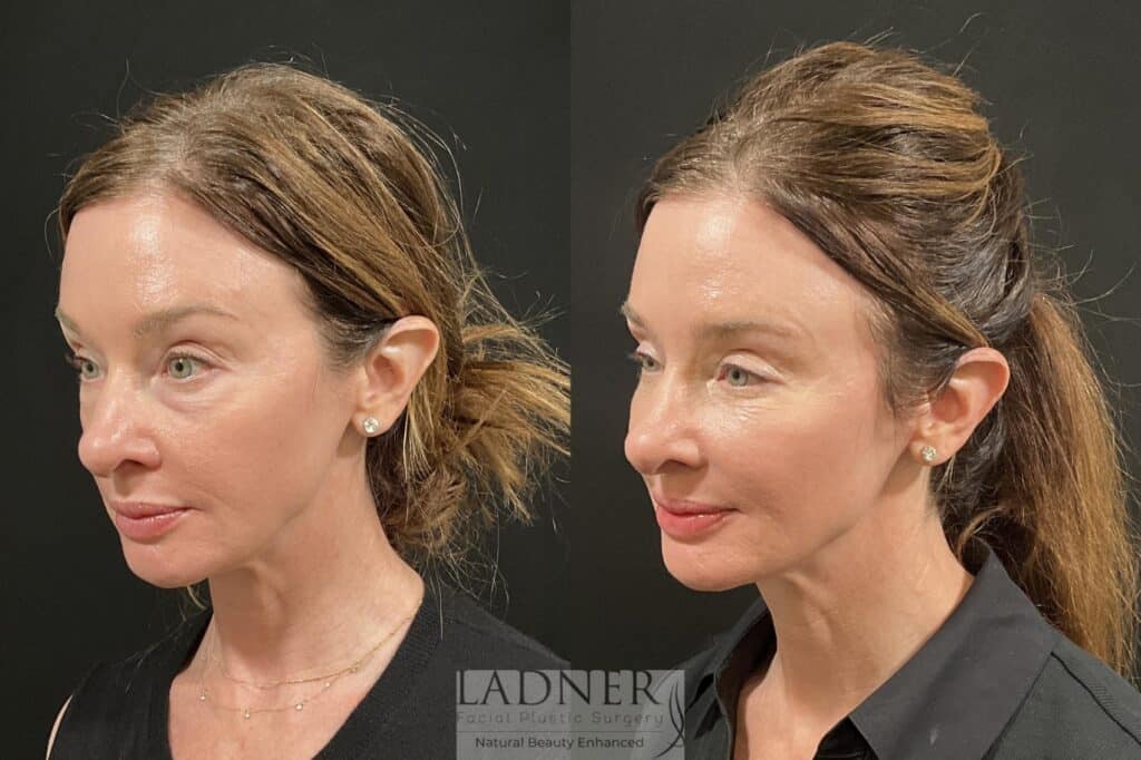 Before and After Image: Lower Blepharoplasty & Facial Fat Transfer - left-front-oblique