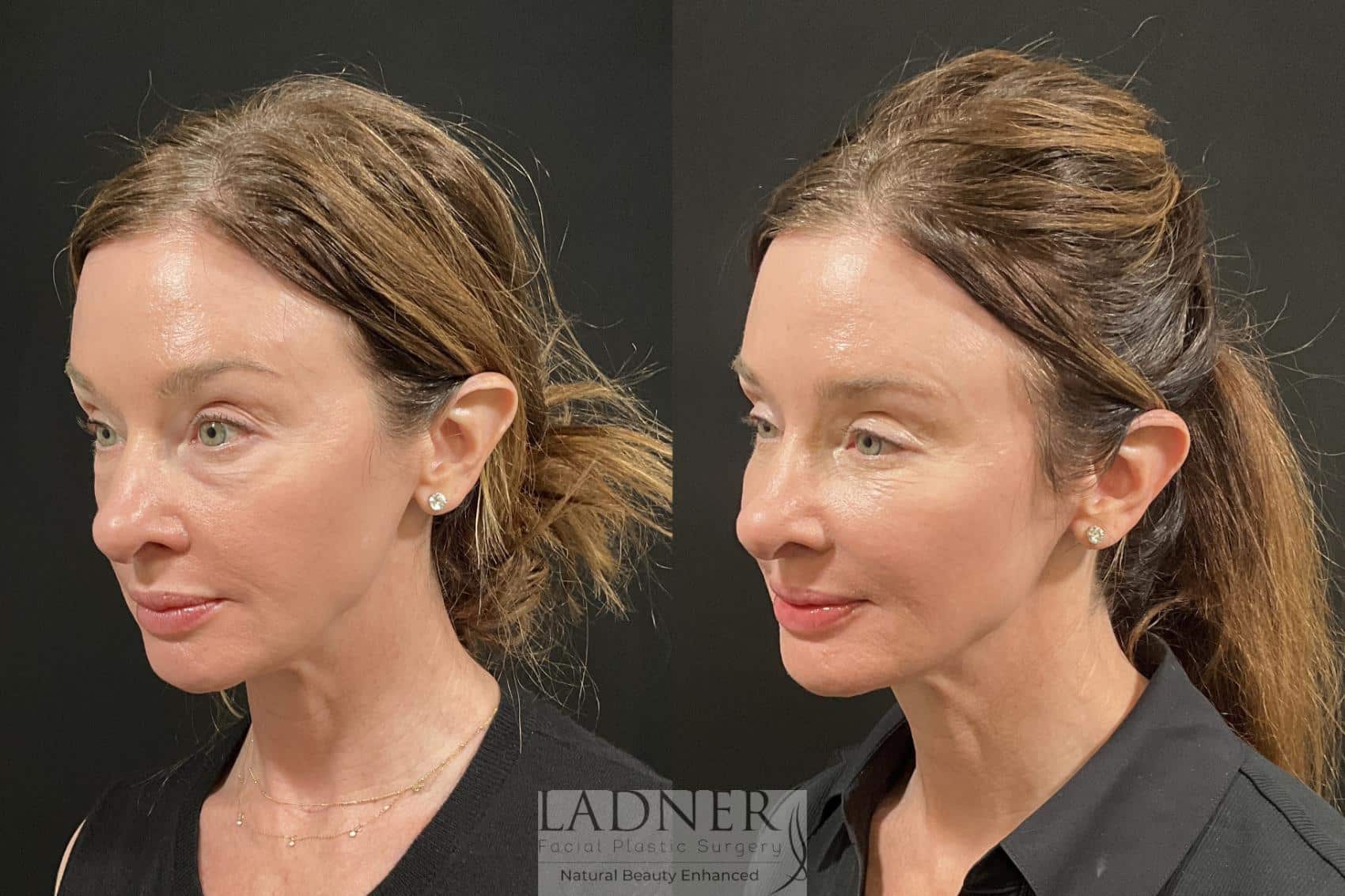 Before and After Image: Eyelid Surgery (Blepharoplasty) - left-front-oblique