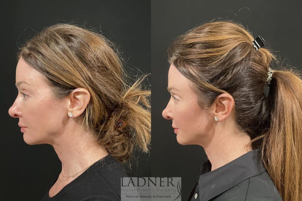 Before and After Image: Lower Blepharoplasty & Facial Fat Transfer - left-side