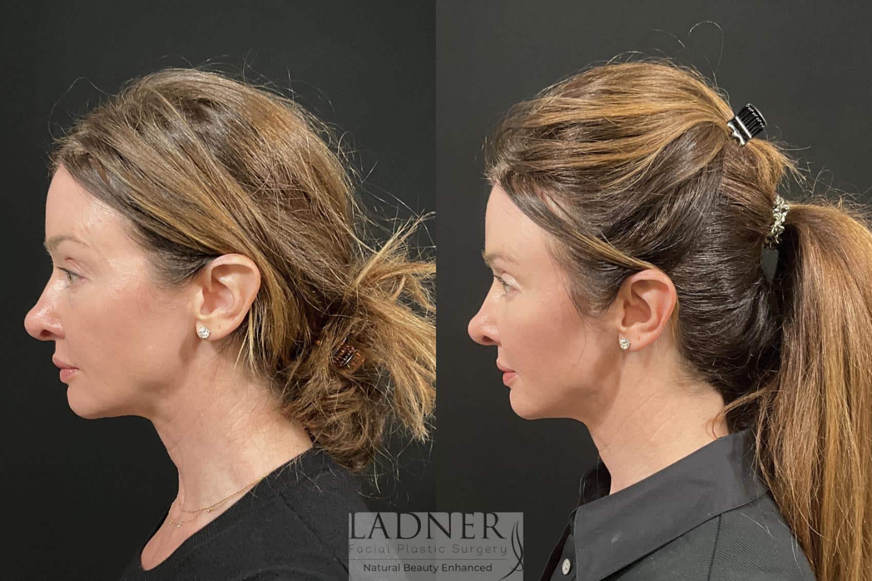 Before and After Image: Eyelid Surgery (Blepharoplasty) - left-side