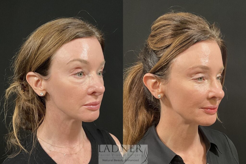 Before and After Image: Lower Blepharoplasty & Facial Fat Transfer - right-front-oblique