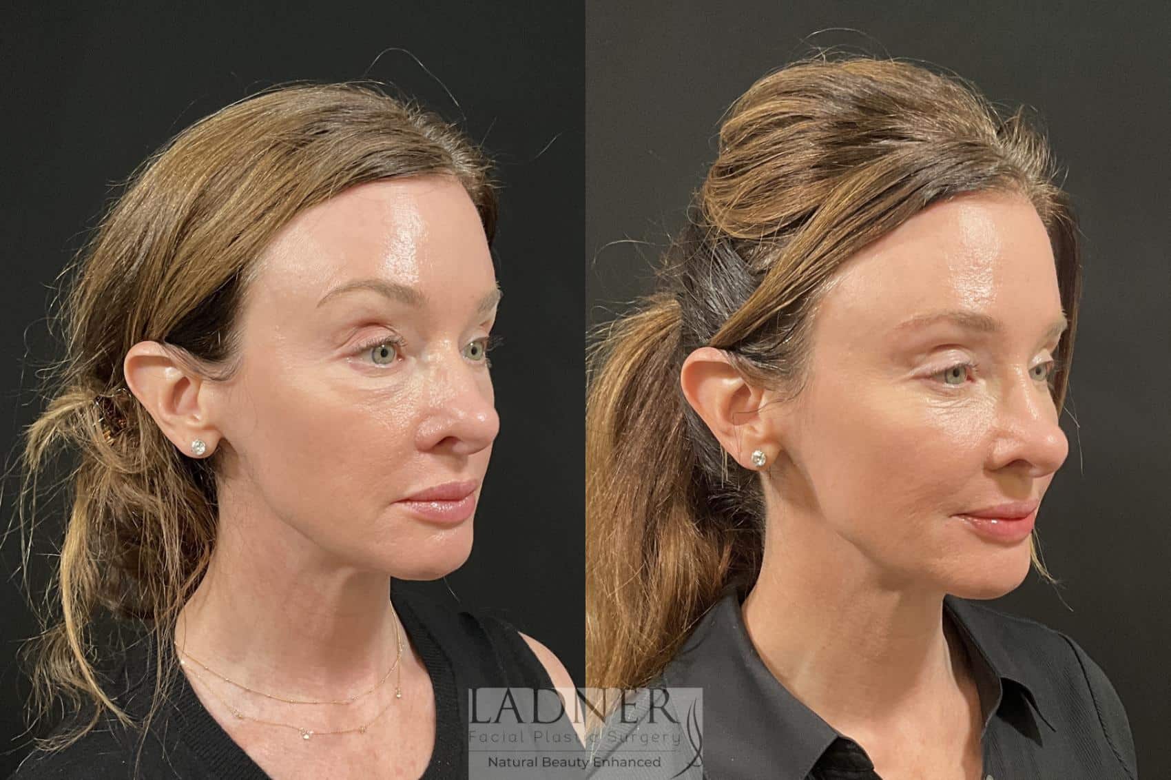 Before and After Image: Eyelid Surgery (Blepharoplasty) - right-front-oblique