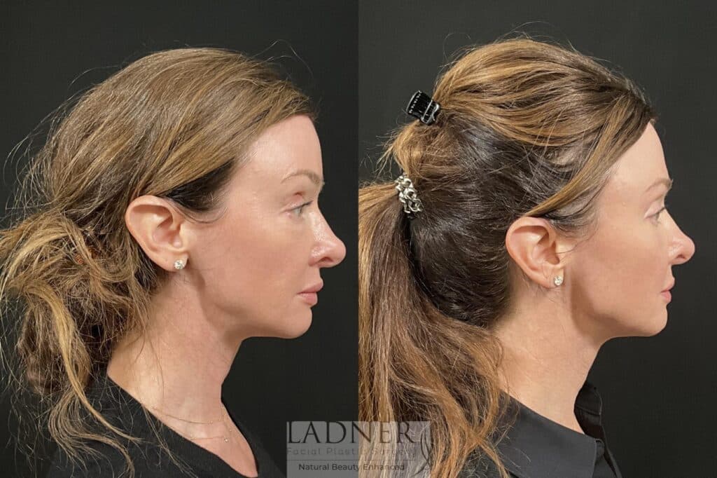 Before and After Image: Lower Blepharoplasty & Facial Fat Transfer - right-side