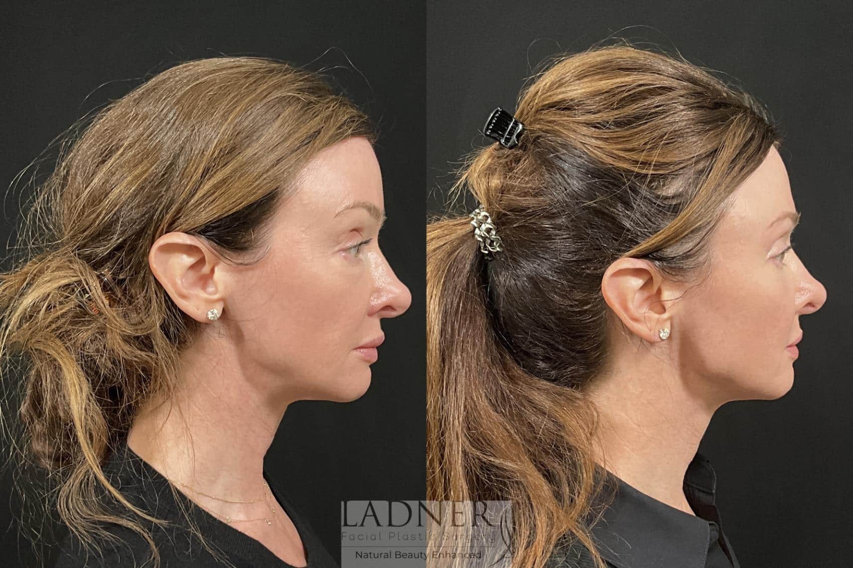 Before and After Image: Eyelid Surgery (Blepharoplasty) - right-side