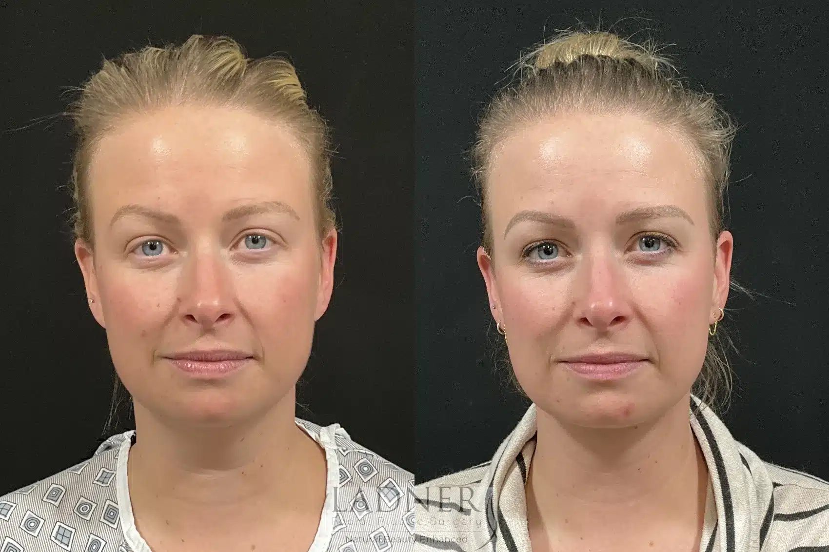 Before and After Image: Minimally Invasive Neck Tightening - front
