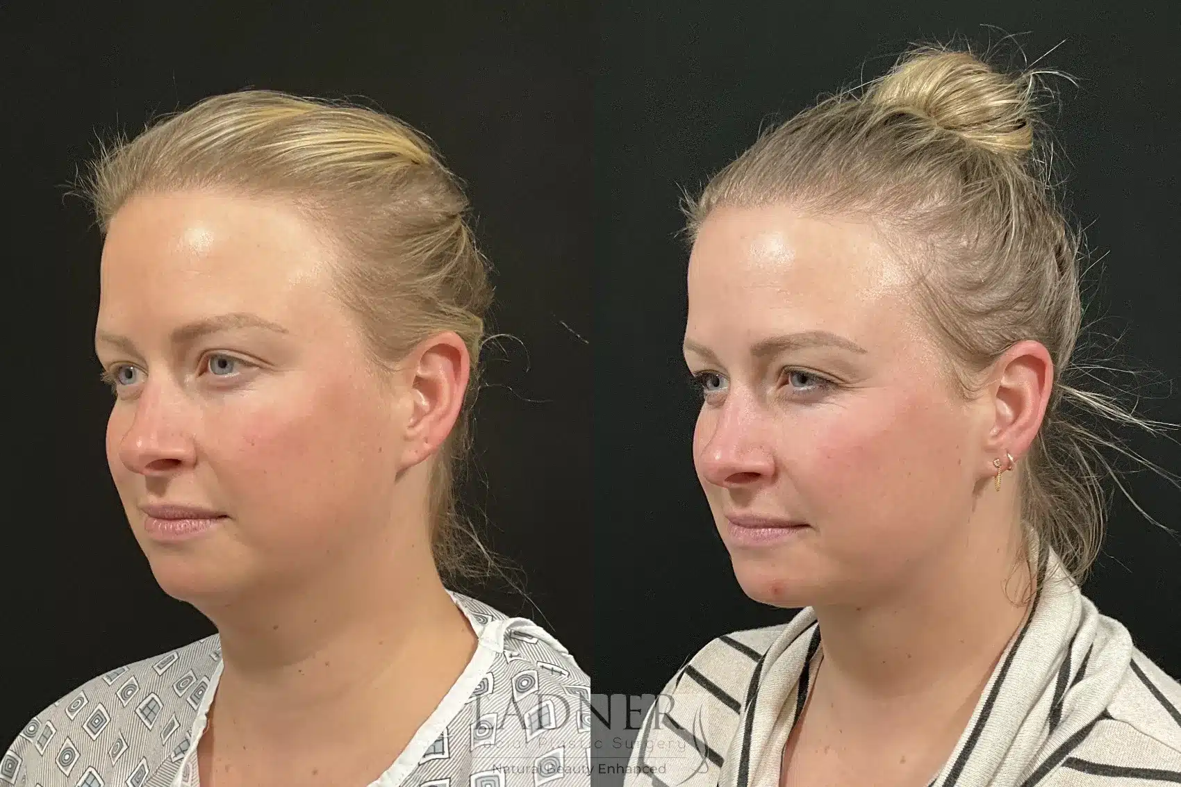 Before and After Image: Minimally Invasive Neck Tightening - left-front-oblique