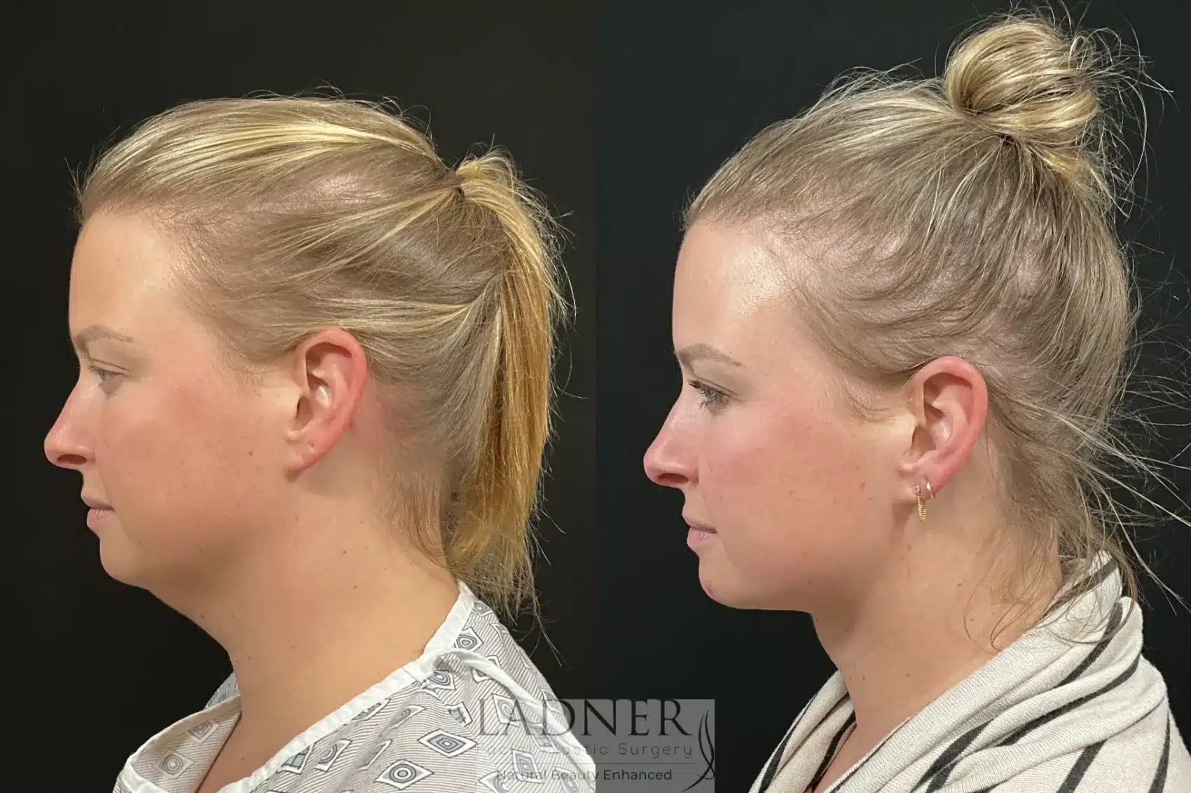 Before and After Image: Minimally Invasive Neck Tightening - left-side