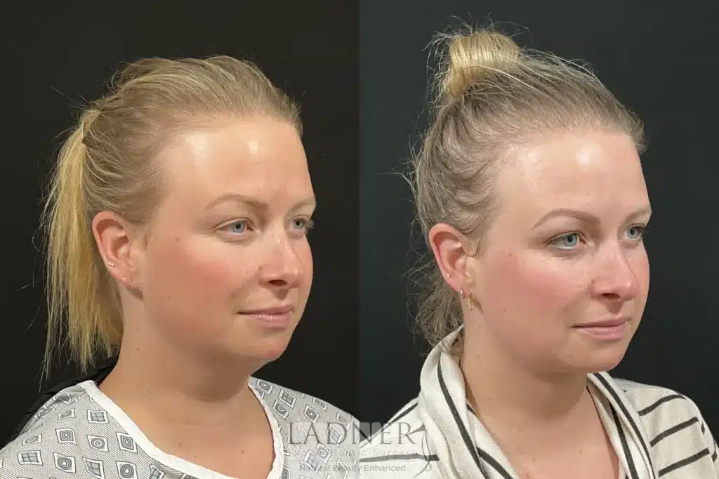 Before and After Image: Minimally Invasive Neck Tightening - right-front-oblique