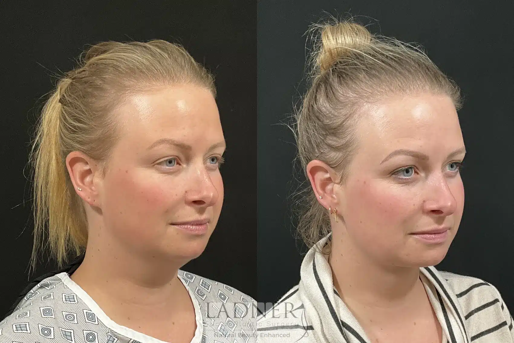 Before and After Image: Minimally Invasive Neck Tightening - right-front-oblique