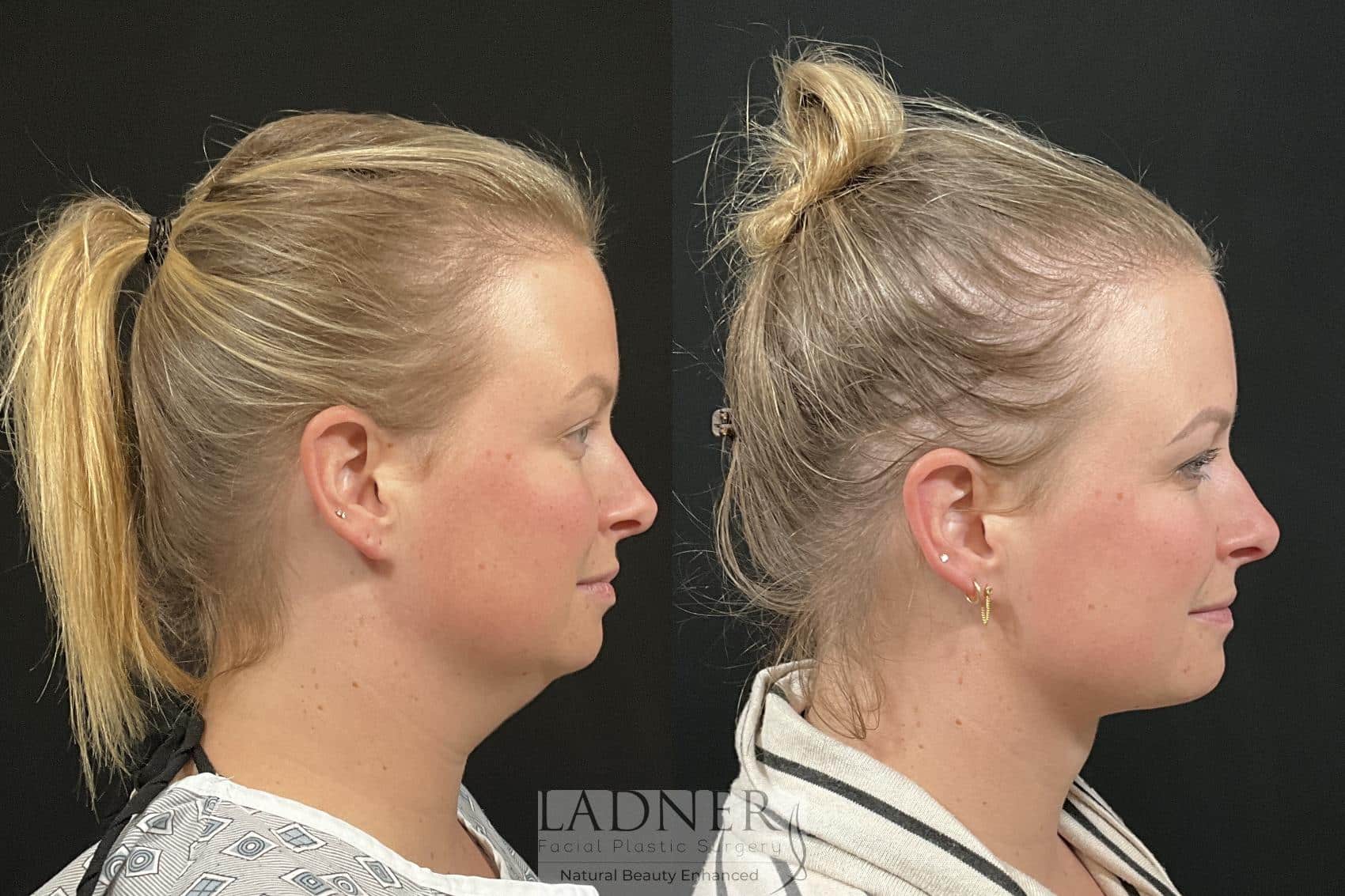 Before and After Image: Minimally Invasive Neck Tightening - front