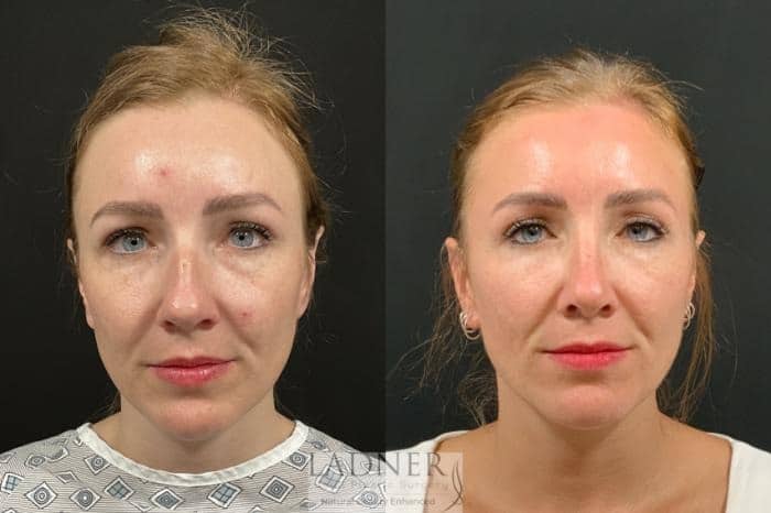 Before and After Image: Rhinoplasty (Nose job) - front