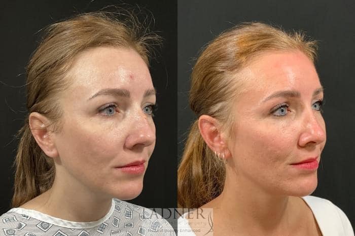 Before and After Image: Rhinoplasty (Nose job) - right-front-oblique