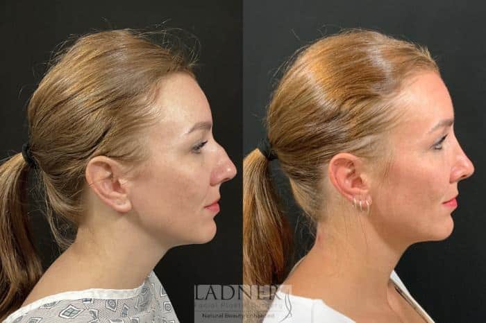 Before and After Image: Rhinoplasty (Nose job) - right-side