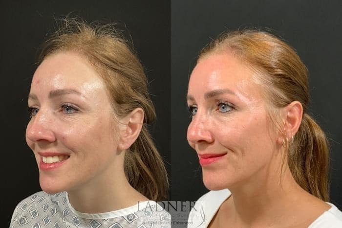 Before and After Image: Rhinoplasty (Nose job) - left-front-oblique