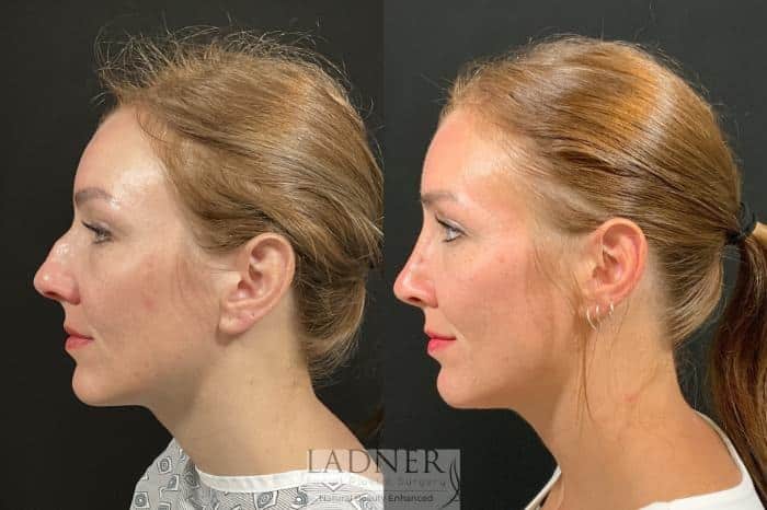 Before and After Image: Rhinoplasty (Nose job) - left-side