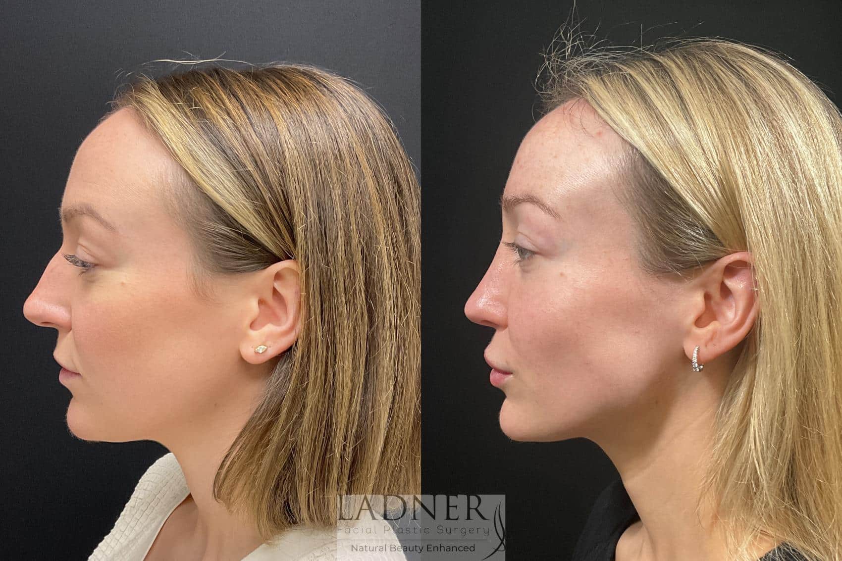 Before and After Image: Rhinoplasty - left-side