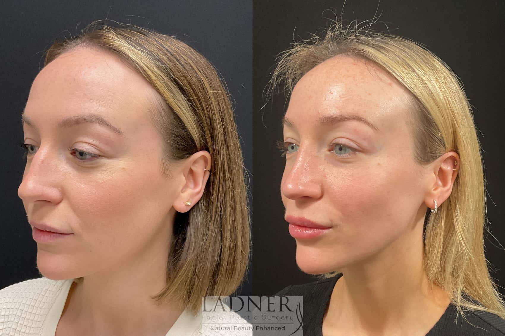 Before and After Image: Rhinoplasty - right-front-oblique