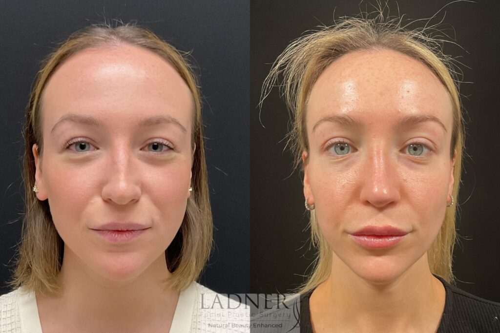 Before and After Image: Rhinoplasty - front