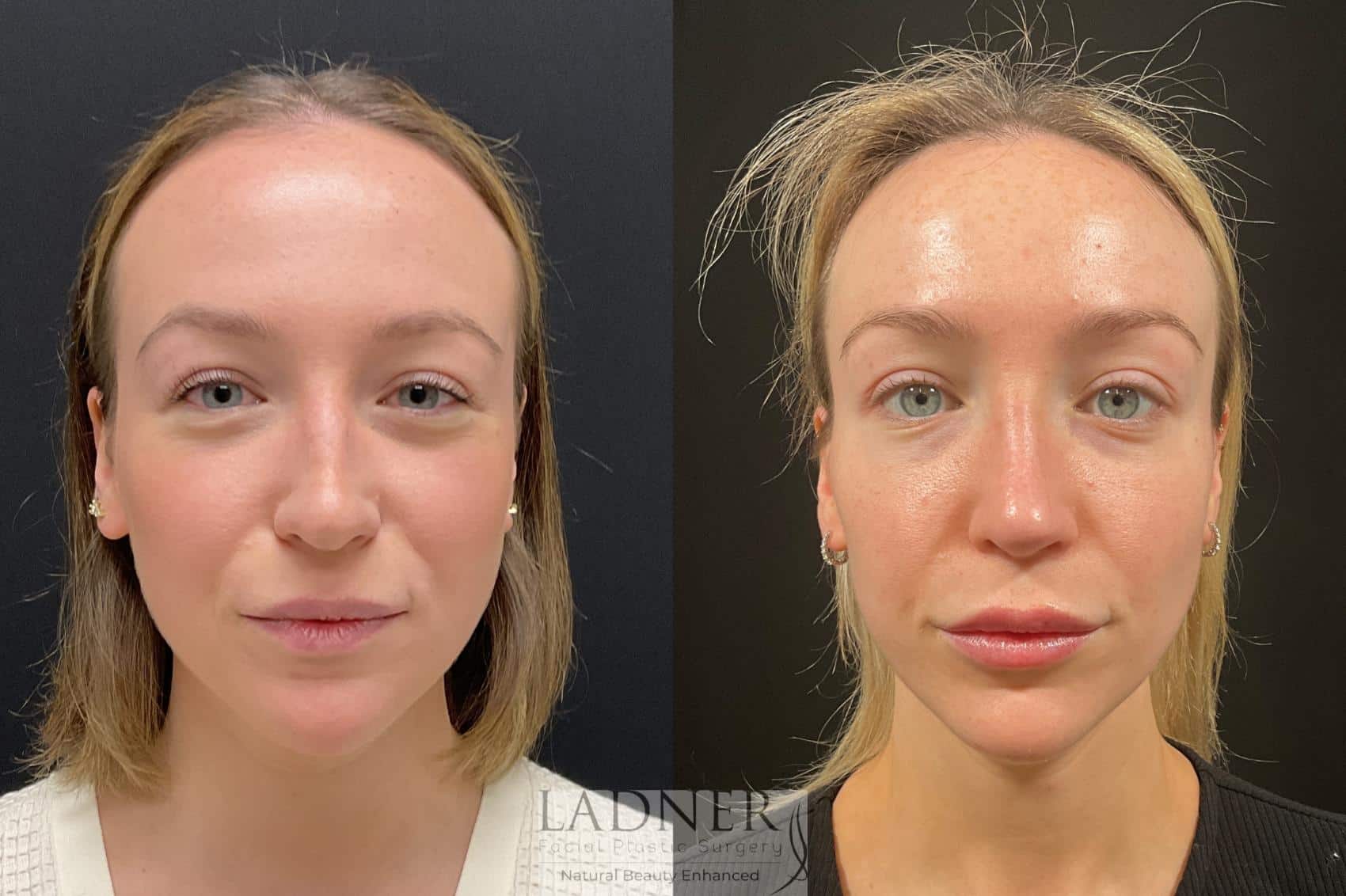 Before and After Image: Rhinoplasty - front