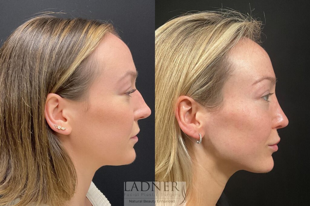Before and After Image: Rhinoplasty - right-side