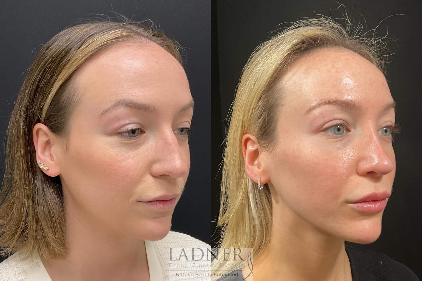 Before and After Image: Rhinoplasty - left-front-oblique