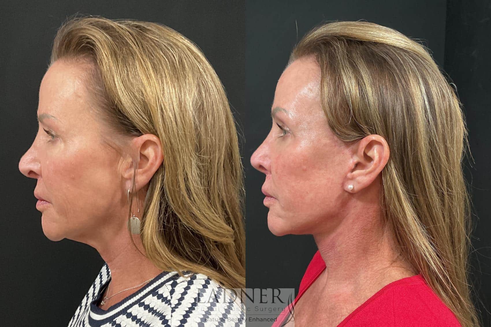 Before and After Image: Deep Plane Lower Facelift, Deep Plane Neck Lift, Fat Transfer to Cheeks - left-side
